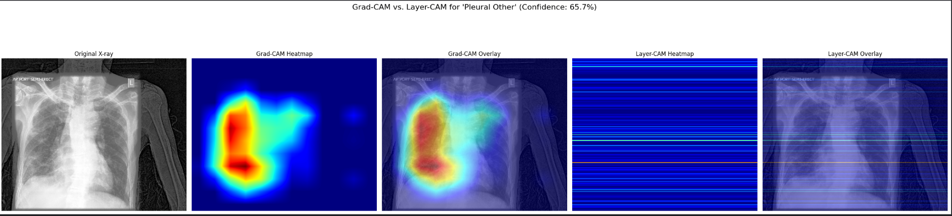 Pleural Other GradCAM