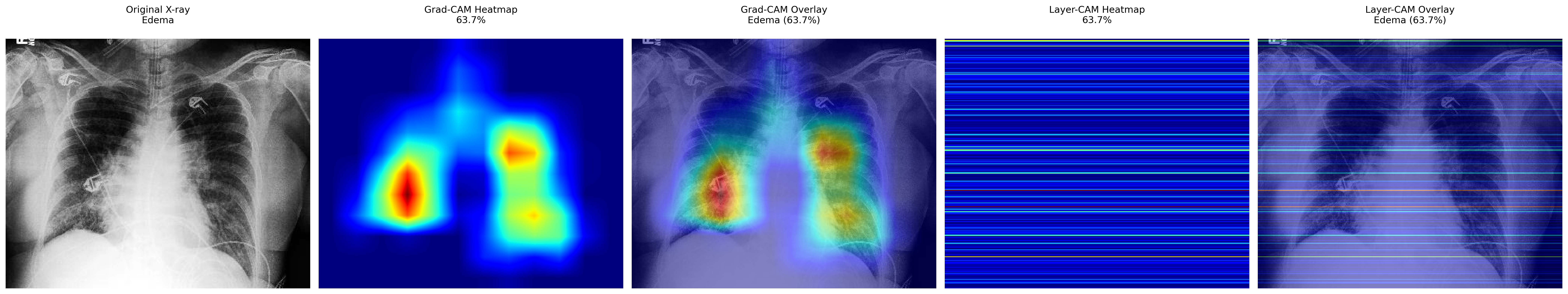 Edema GradCAM